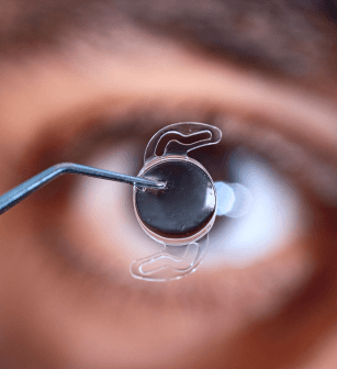 Cirurgia de Catarata Ocular