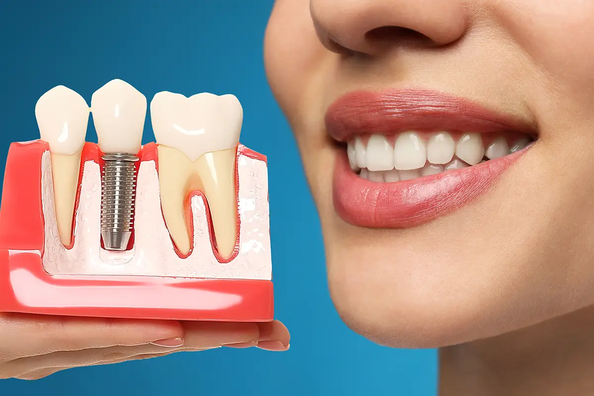 Types of Dental Implant