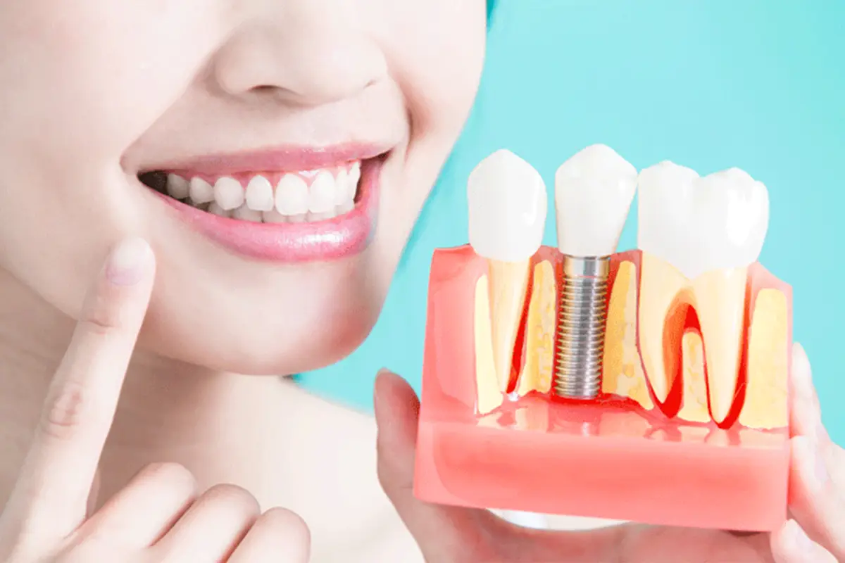 Dental Implant Cost