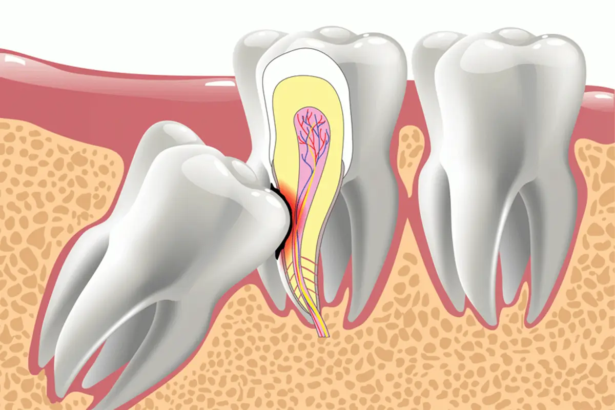 Impacted Teeth