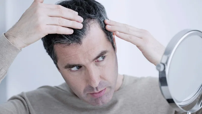 10 Best Treatments For Thinning Hair in Men