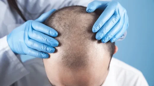 Can a Completely Bald Person Have a Hair Transplant?