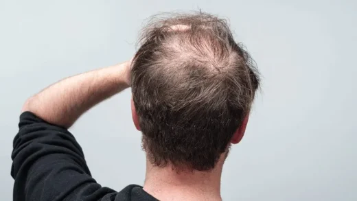 Hair Loss Due to Thyroid