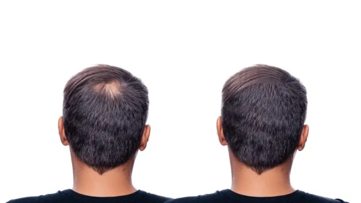 Success Rate of Hair Transplant