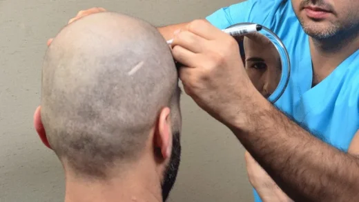 Hair Transplant Sun Exposure