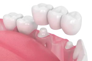 Dental Bridge in Turkey