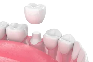 Dental Crown in Turkey
