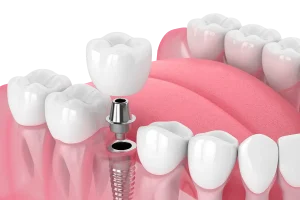 Dental Implant in Turkey