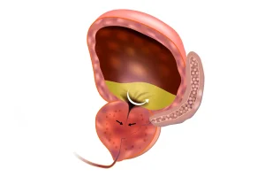 Prostatectomy in Turkey