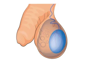 Varicocele Surgery in Turkey