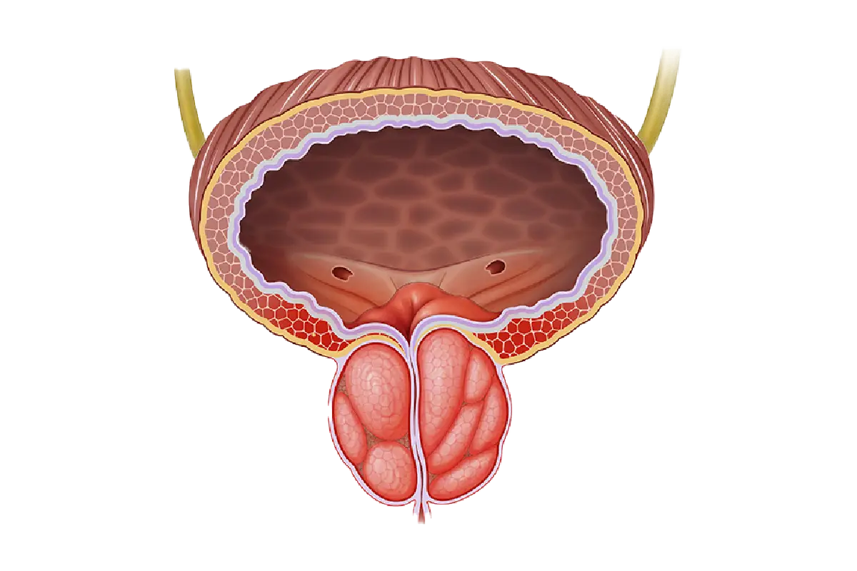 Prostatectomy or HoLEP? Understanding the Surgical Options for Prostate Cancer