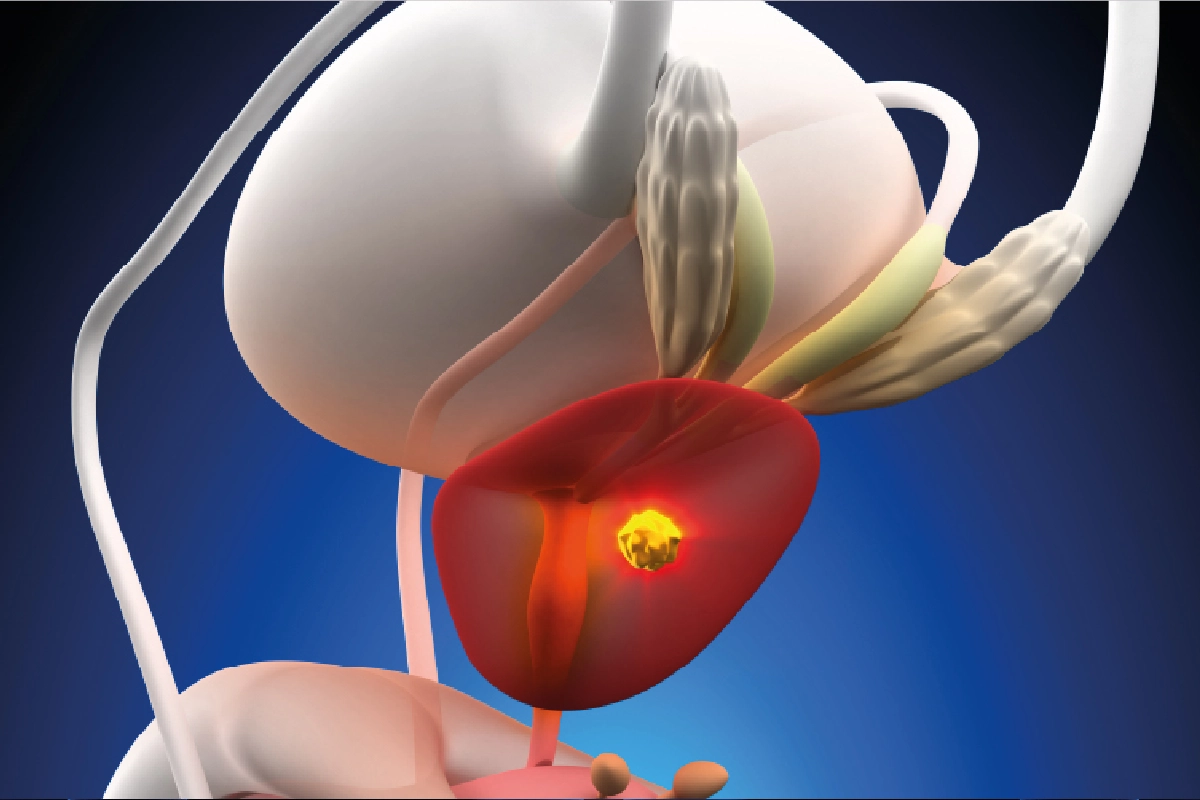 How Prostatectomy Can Change Your Future