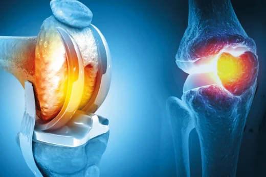 Robotic vs. Traditional Knee Replacement 6 knee-replacement