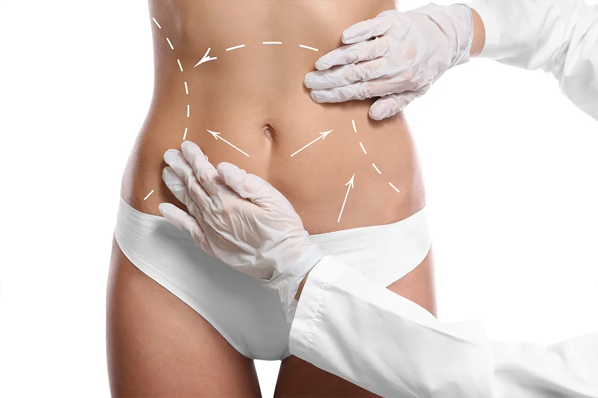 Is Liposuction the Answer to Stubborn Fat?