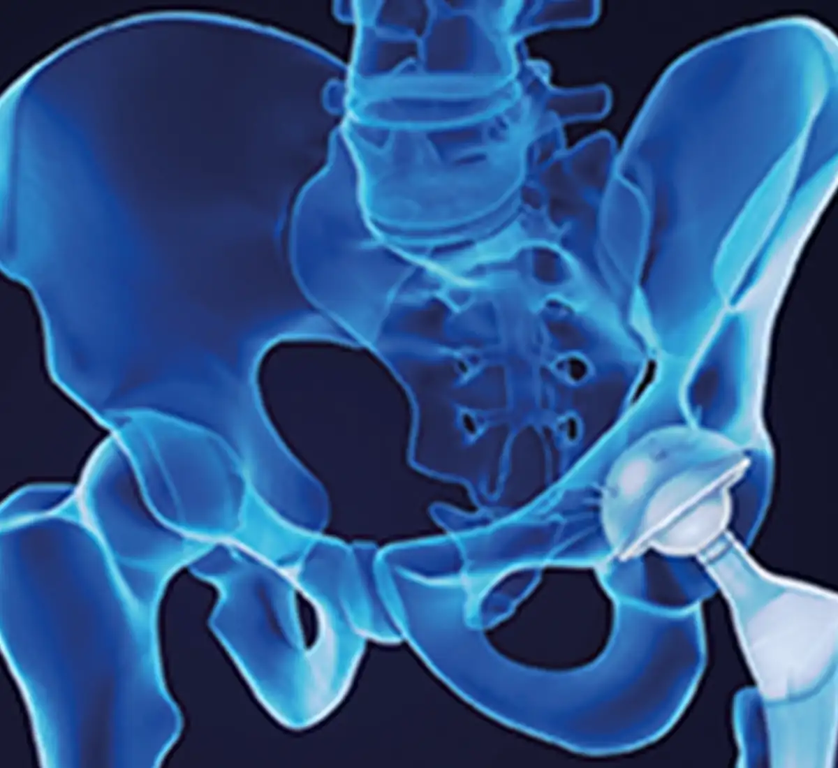 Hip Replacement in Turkey