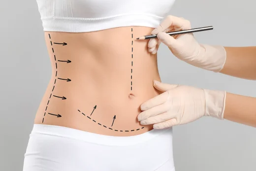 Consejos para una recuperación rápida después de una abdominoplastia