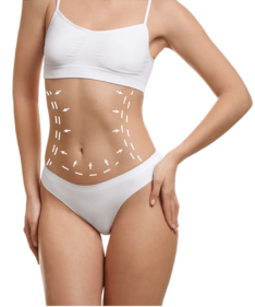 tummy_tuck_operation