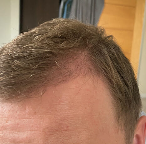 Hair Transplant After 4 Months