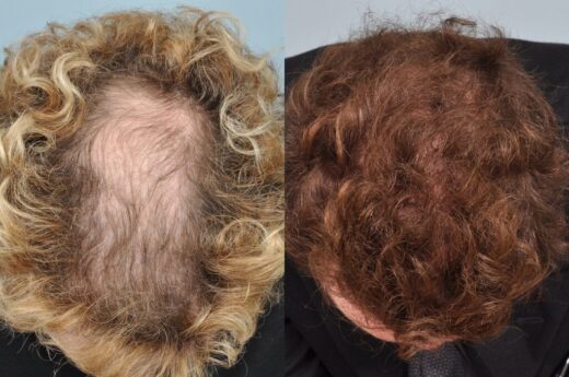 Who Is Eligible for an Artificial Hair Transplant?