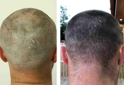 Hair Transplant After 2 Weeks