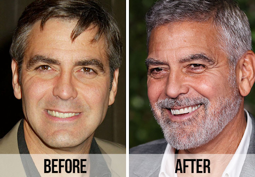 Introduction: 6 Celebrities Who Got Veneers – Before and After Transformations