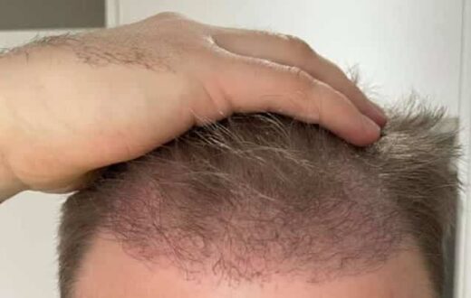 Hair Transplant After 3 Months