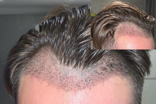 Hair Transplant After 7 Days