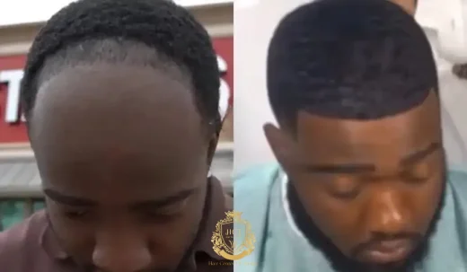 Did JiDion Get A Hair Transplant?