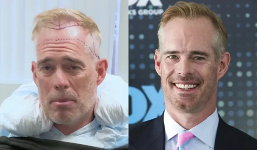 Why did Joe Buck undergo several hair transplantations?