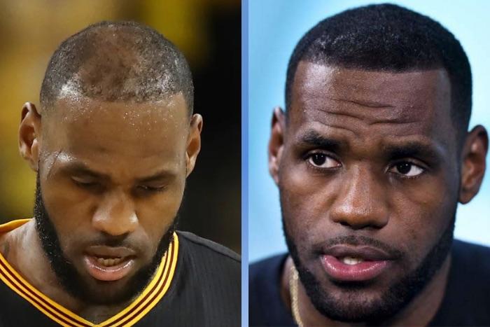 Haartransplantation bei LeBron James: Eine Transformation im Laufe der Jahre