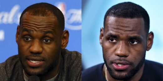 LeBron James Before and After Hair Transplant