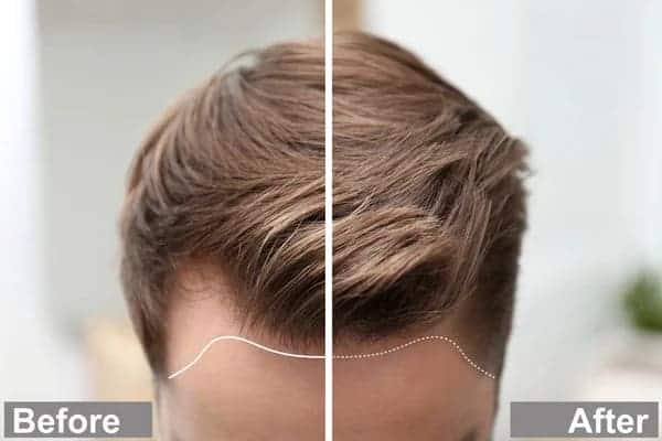 Mature vs. Receding Hairline: Understanding the Difference