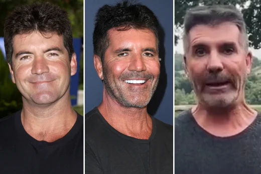 Simon Cowell Before and After Plastic Surgery: A Visual Journey