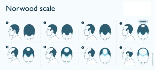 The Norwood Scale, Class 1–7: Understanding Male Pattern Hair Loss