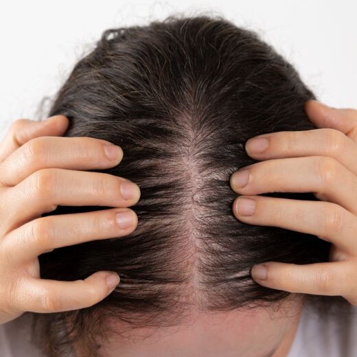 PCOS-Hair-Loss-Causes-Treatments-Home-Remedies-and-Support