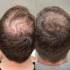 Ozempic Hair Loss: Is It Permanent?