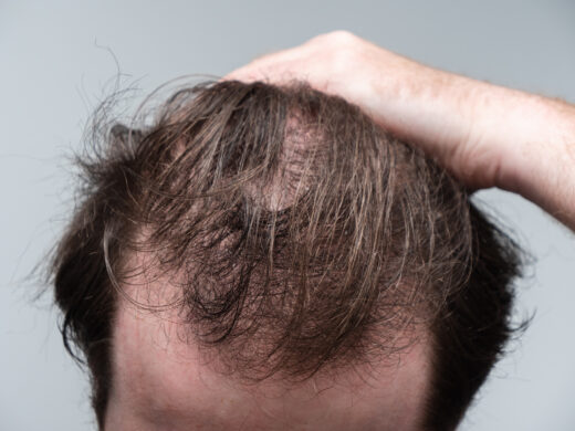 Why Does Ozempic Cause Hair Loss