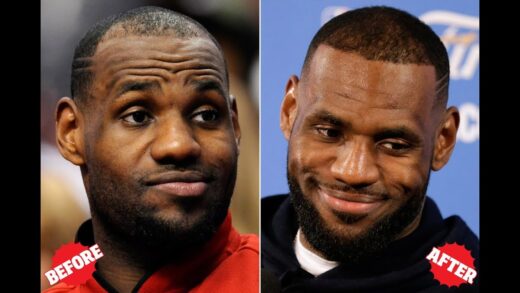 LeBron James Hair Transplant: A Transformation Over the Years