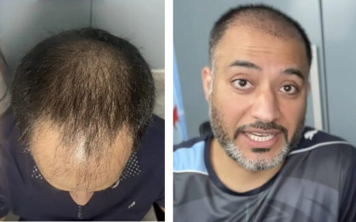 Hair Transplant After 1 Month