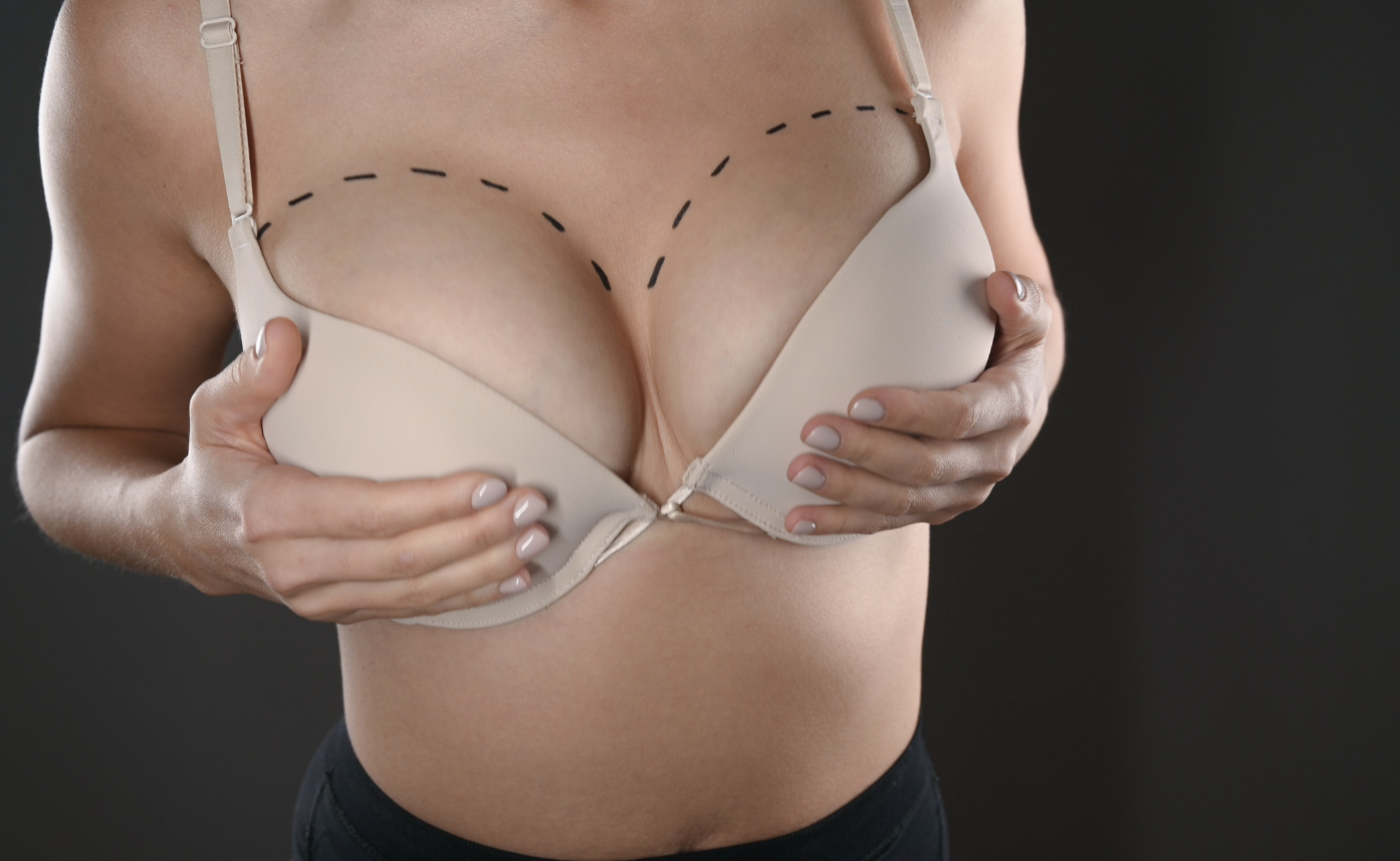 Breast Augmentation: Over a Million Women Have Undergone This Procedure in the UK Alone