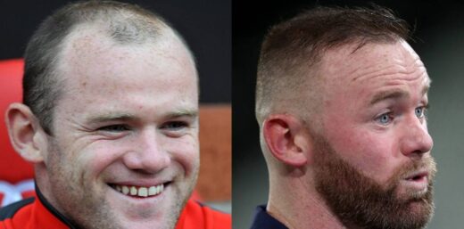 The Beginning of Wayne Rooney's Hair Loss Story