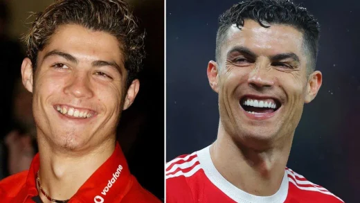 cristiano-ronaldo-teeth-veneers