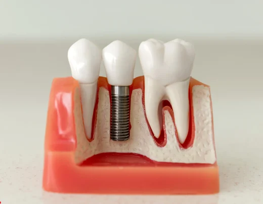 Dental Implants: Hungary or Turkey?