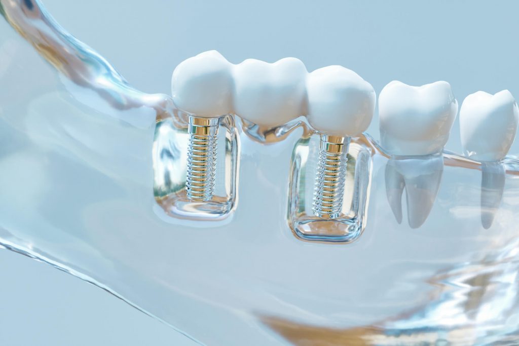 Impianti dentali convenienti nel Regno Unito: come tagliare i costi senza compromettere la qualità