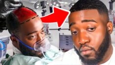 Did YouTube’s Prank Star JiDion Get A Hair Transplant