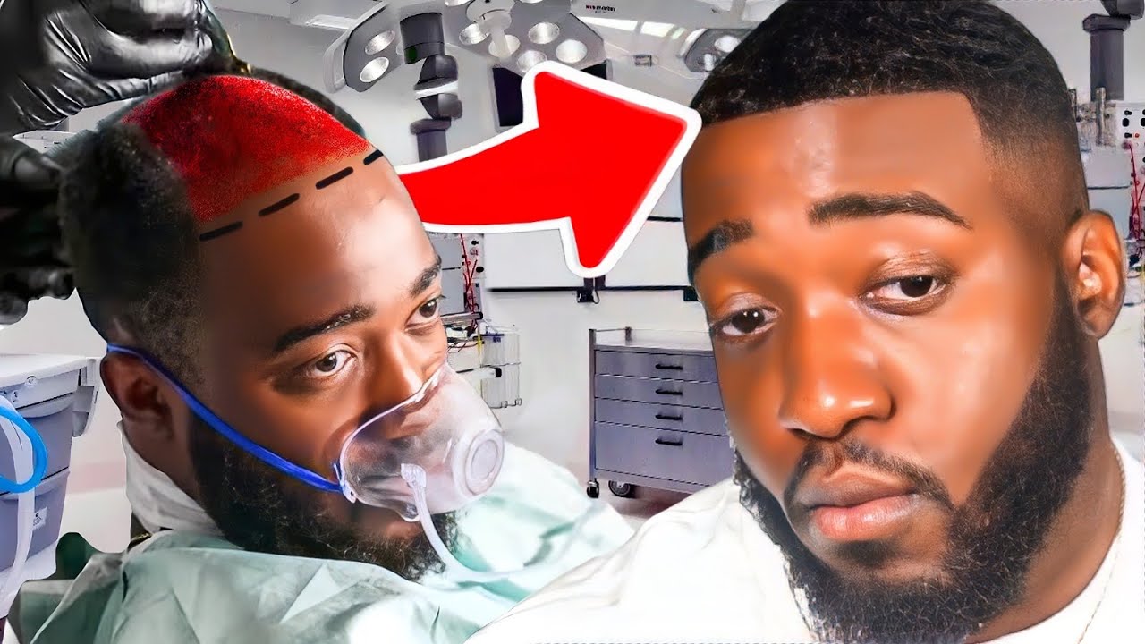 Did YouTube’s Prank Star JiDion Get A Hair Transplant?