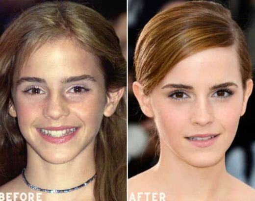 emma watson teeth veneers