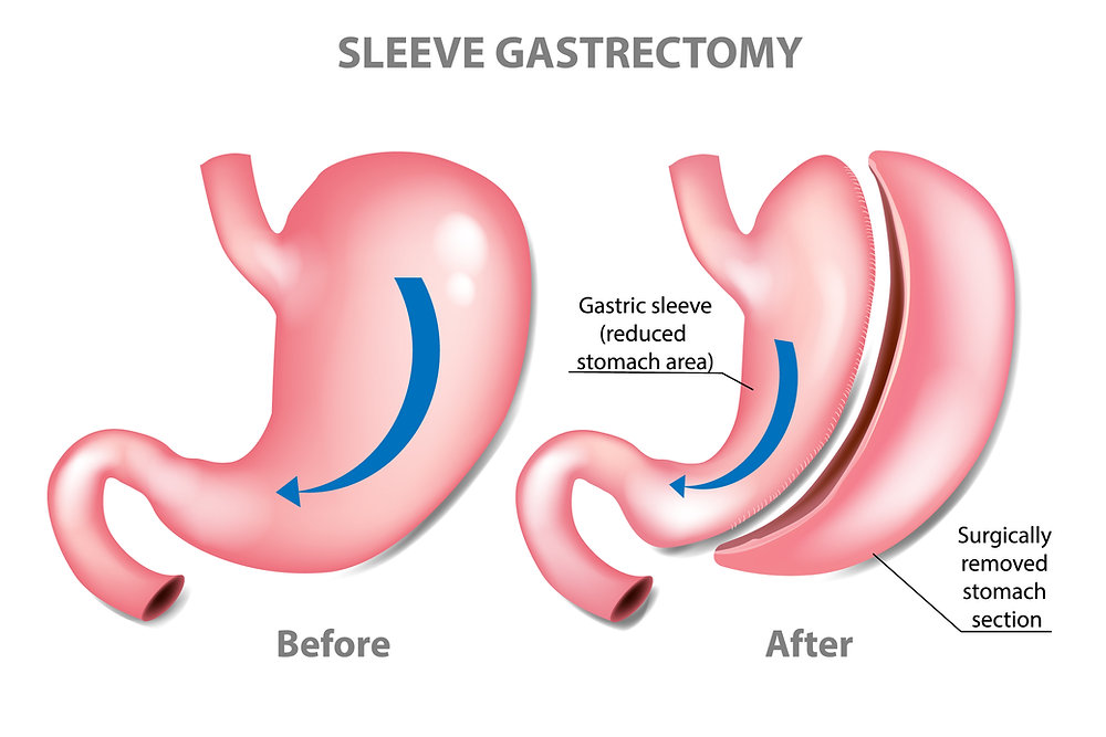 Gastric Sleeve-chirurgie in Turkije