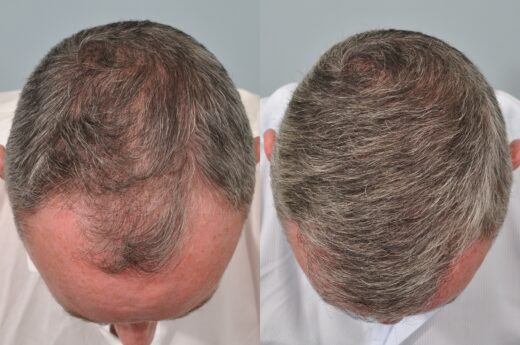 Hair Transplant After 4 Months