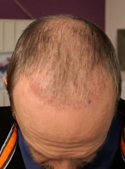 Hair Transplant After 2 Months